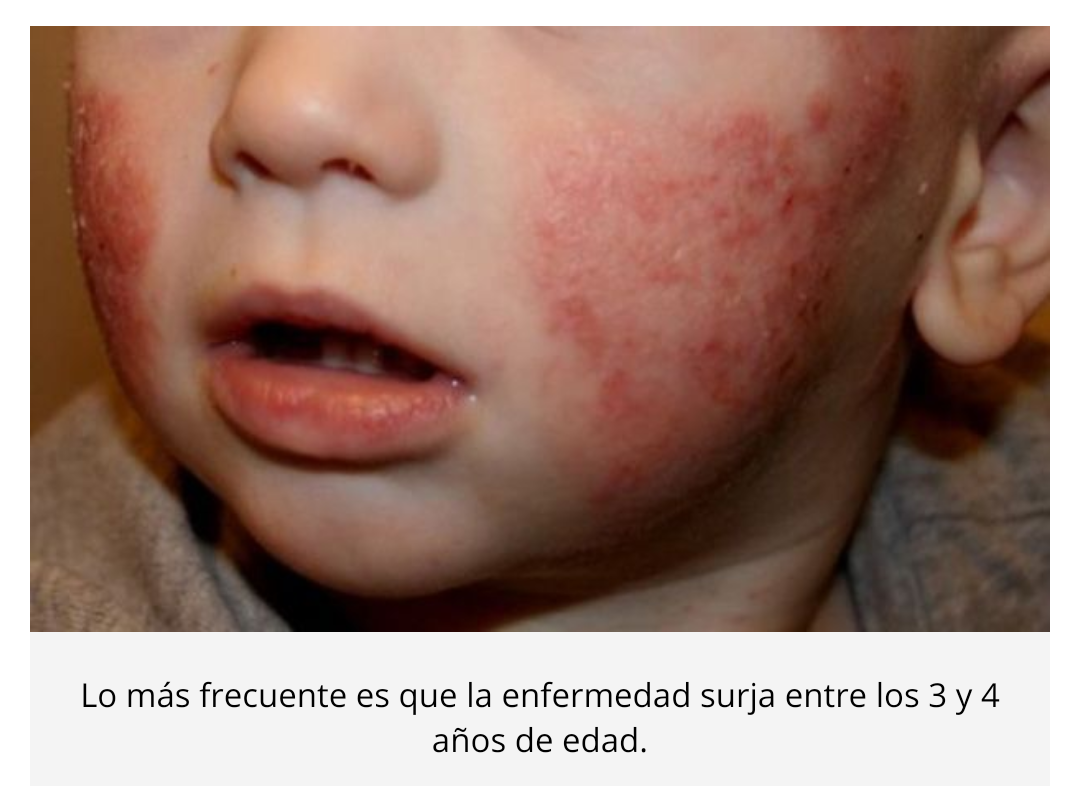 La Dermatitis At Pica Es La Patolog A M S Com N En Consultas De